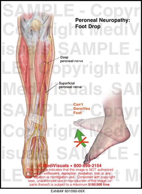 Medivisuals Peroneal Neuropathy Foot Drop Medical Illustration