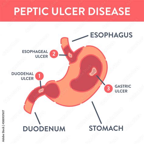 Peptic Ulcer Stomach Disease Infographic Poster Endoscopic Image Of Stomach With Duodenal