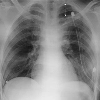 Chest X Ray Performed On Supine Decubitus After Chest Tubes My XXX