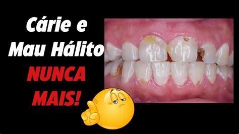 Dentista Revela Os Maiores Segredos Para Cuidar Dos Dentes E Evitar A