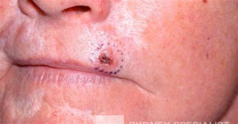 Early Stage Skin Cancer Precancerous Skin Lesions And Skin Cancer