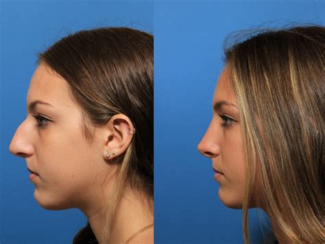 Non Surgical Nose Job Before And After Elhorizonte
