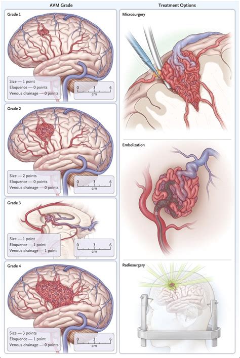 Review Article Examples Of Spetzlermartin Grades 1 4 Arteriovenous