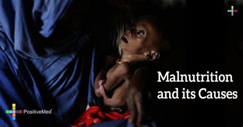 Malnutrition And Its Causes Positivemed