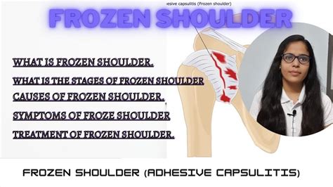 Frozen Shoulder Adhesive Capsulitis Stages Causes Symptoms And