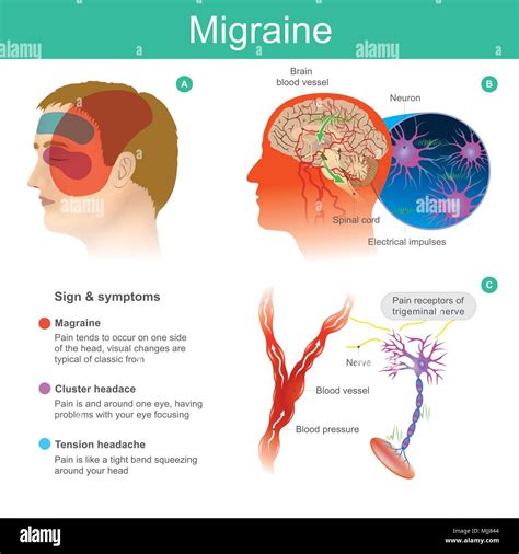 Cluster Headaches Diagram