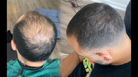 Top 48 Image Buzz Cut Thinning Hair Before After Thptnganamst Edu Vn