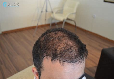 What If Hair Transplant Fails Fashion Hairstyle