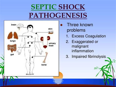 Ppt Septic Shock Powerpoint Presentation Free Download Id