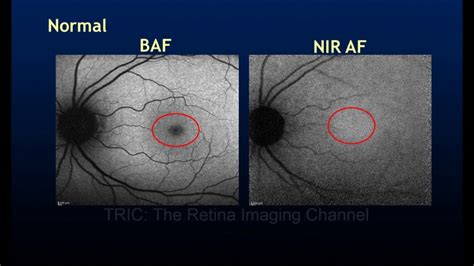 The Black And White Fundus Images Red Free Autofluorescence And