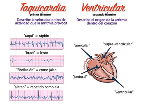Arritmia Extra Sistólica Ventricular