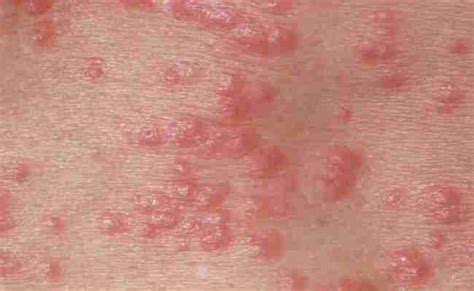 8 Common Types Of Rashes And What They Look Like In 2021 Rashes Heat