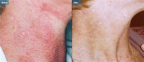 Lasers Red Marks Poikiloderma Is A Reddish Brown Discoloration Of