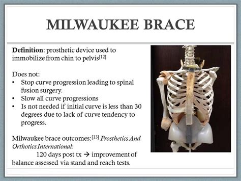 Scheuermanns Kyphosis Video Class Of 2015 Milwaukee Brace Spinal