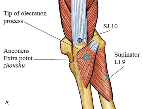 Supinator Syndrome The Great Imitator For Lateral Epicondylitis