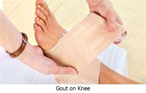 What Are The Symptoms Of Gout In Your Knee