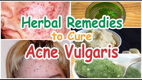 Best Herbal Remedies To Get Rid Of Acne Vulgaris Natural Pimples