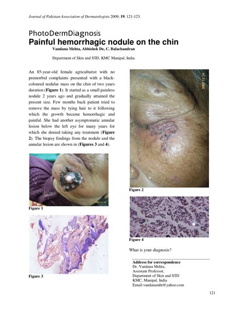 Pdf Painful Hemorrhagic Nodule On The Chin