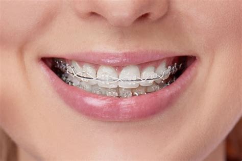 Silver Braces In Chevy Chase Md Dr Jill Bruno