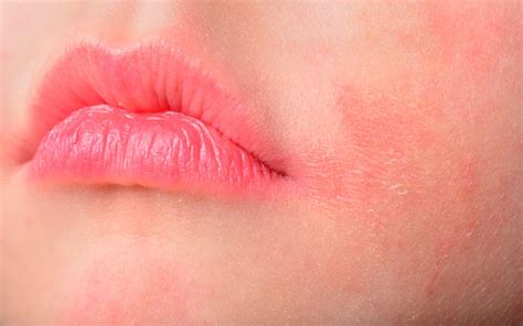 How Can You Prevent Rashes On Your Lips Skinkraft