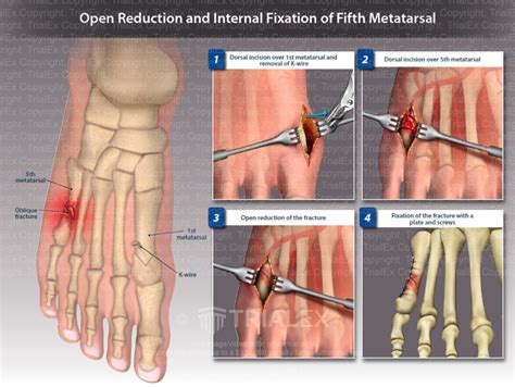Open Reduction And Internal Fixation Of The Fifth Metatarsal Tr