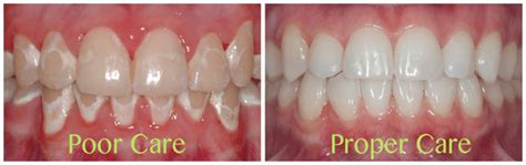 How To Fix Decalcification After Braces