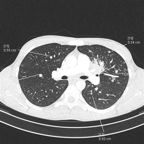 Chest Ct Scan Of The Patient Interstitial Thickening And Bilateral