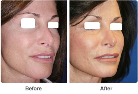 Laser Skin Resurfacing In Dubai Laser Skin Care Clinic Dubai