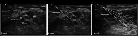 Comparison Of Single‑ And Triple‑injection Methods For Ultrasound