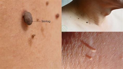 6 Skin Tags Remedies Top Natural Remedy