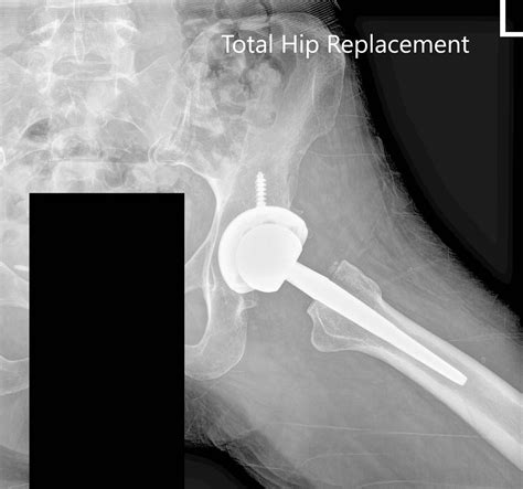 Case Study Bilateral Total Hip Arthritis In 66 Yr Old Male