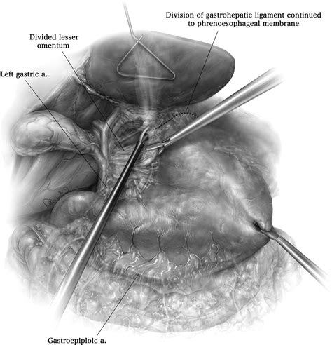 Management Of Epiphrenic Esophageal Diverticula Operative Techniques