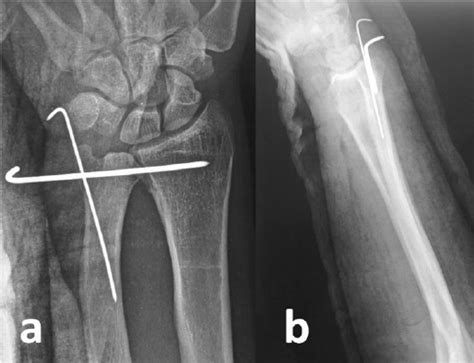 Post Operative Radiographs Showing The Proper Reduction And Fixation Of