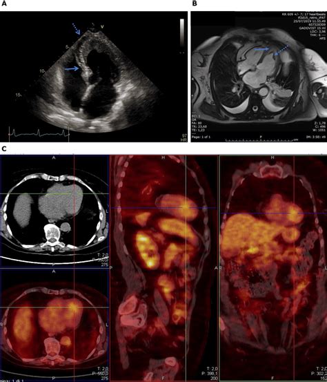 A Echocardiography Apical 4 Chamber View In A Patient With