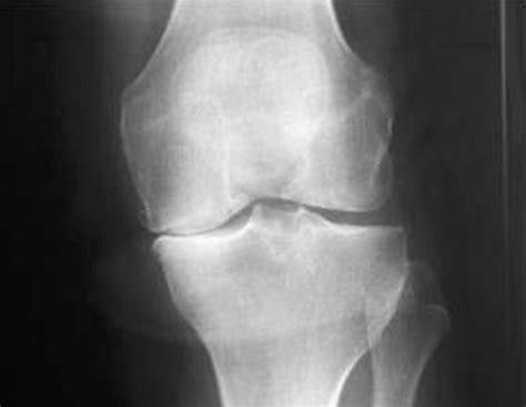 The Orthopaedic Approach To Managing Osteoarthritis Of The Knee The Bmj