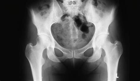Pelvis X Ray Purpose Procedure And Risks