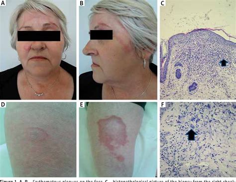 Figure From Granulomatous Skin Disease With A Histological Pattern Of