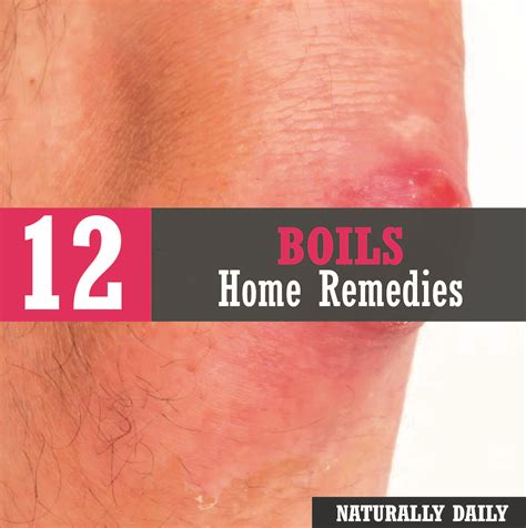 How To Get Rid Of Boils Fast 17 Home Remedies That Work Get Rid Of Boils Home Remedies For