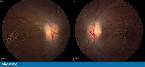 A 16 Year Old Girl With Bilateral Optic Disc Edema
