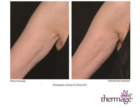 How Long Do Thermage Results Last Radiance Skincare And Laser Medspa