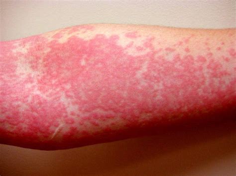 Extremely Rare Disorder Aquagenic Urticaria Allergic To Water Medizzy