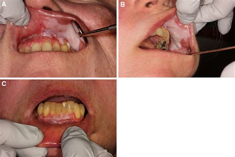 Proliferative Mostly Homogenous Leukoplakia With Involvement Of
