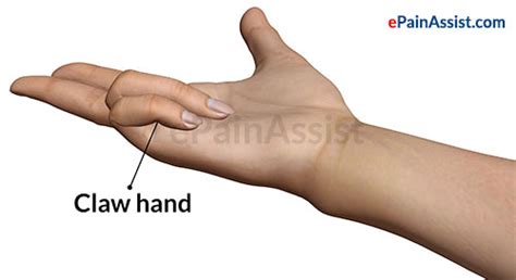 Ulnar Nerve Palsyclaw Hand Picture