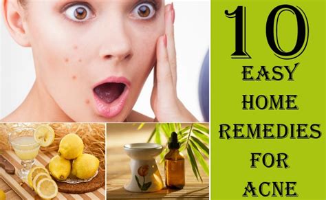 10 Home Remedies For Acne Natural Remedies To Get Rid Of Acne