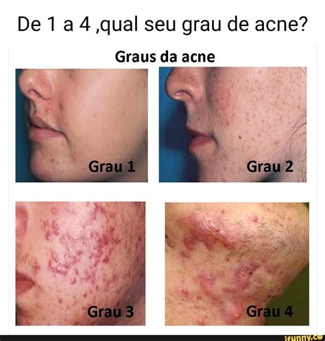 De A Qual Seu Grau De Acne Graus Da Acne Grau Grau Grau Gire