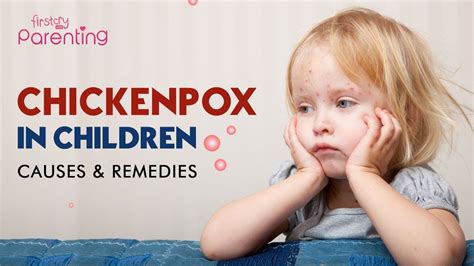 Chickenpox In Children Causes Signs And Treatment Youtube