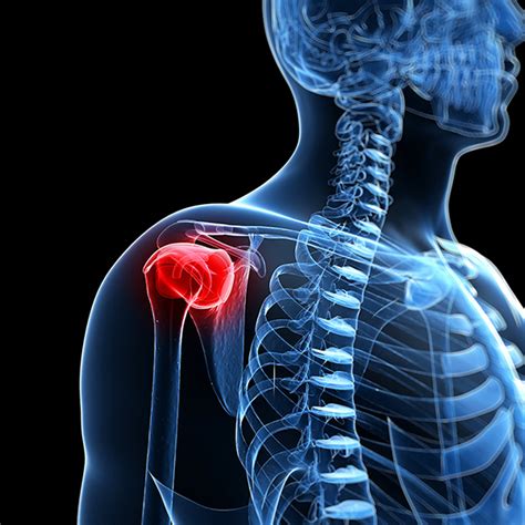 Dislocated Shoulder Its Potential Complications And Treatments