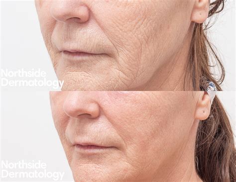 Co2 Laser Resurfacing Treatment In Melbourne