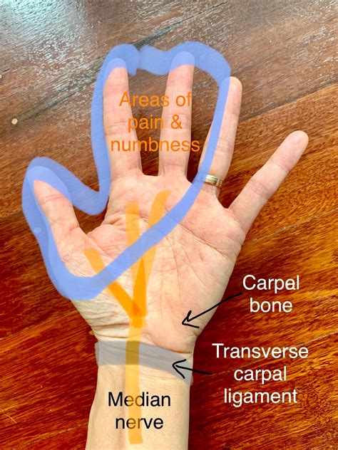 Acupuncture For Carpal Tunnel Syndrome Chatswood Healing Hands