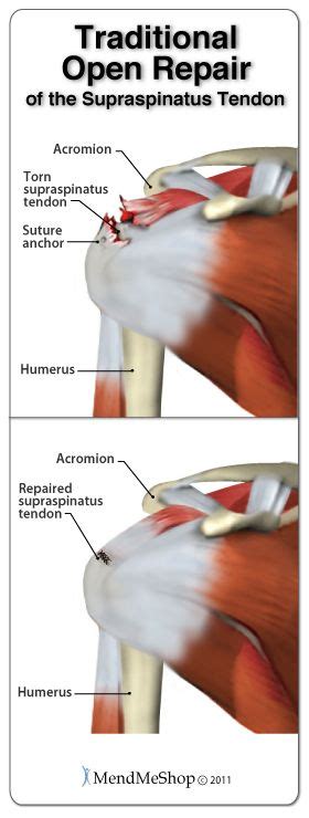 The _ ligament covers the superior gh ligament anterosuperiorly and fills space between tendons of supraspinatus and subscap muscles. Traditional open repair surgery to repair the ...